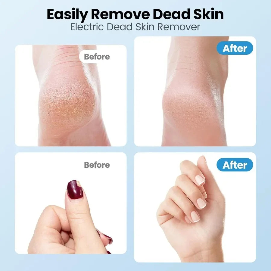 TLXT Electric Callus Remover 2 In 1 Foot File Effective